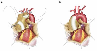 Early and Long-Term Follow-Up for Chronic Type B and Type Non-A Non-B Aortic Dissection Using the Frozen Elephant Trunk Technique